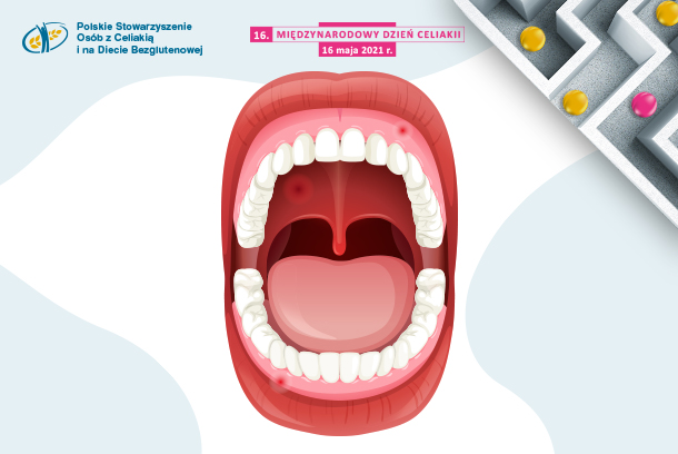 MDC 2021: Objawy celiakii w jamie ustnej – niedostrzegany problem?