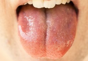 Objawy celiakii w jamie ustnej