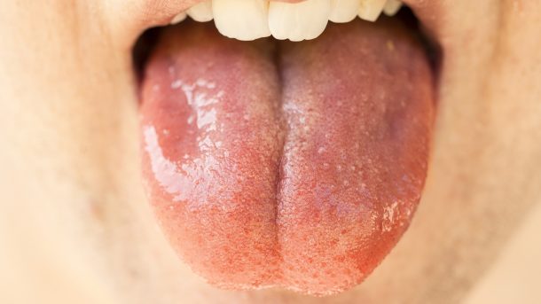 Objawy celiakii w jamie ustnej